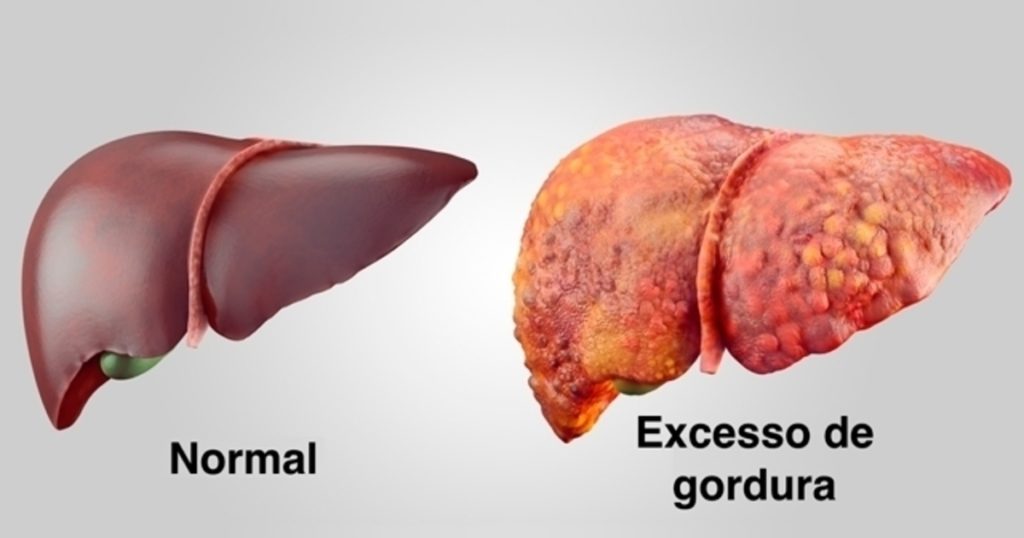 Esteatose Hepática 1024x538 - ESTEATOSE HEPÁTICA SINTOMAS CAUSA E TRATAMENTO