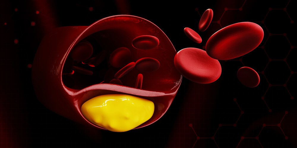 HDL LDL E TRIGLICERÍDEOS - COLESTEROL ALTO SINTOMAS CAUSA E TRATAMENTO