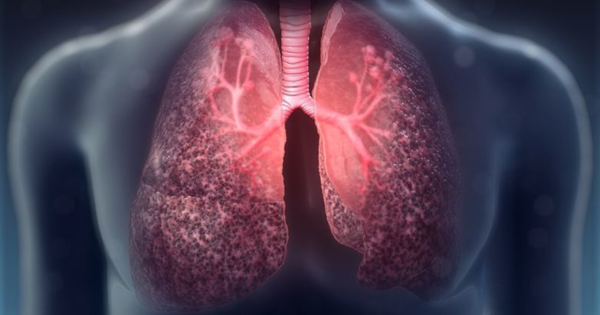 Porque Pessoas Com Fibrose Cistica Nao Podem Ficar Perto