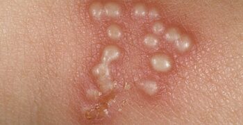 HERPES SINTOMAS CAUSAS E TRATAMENTOS