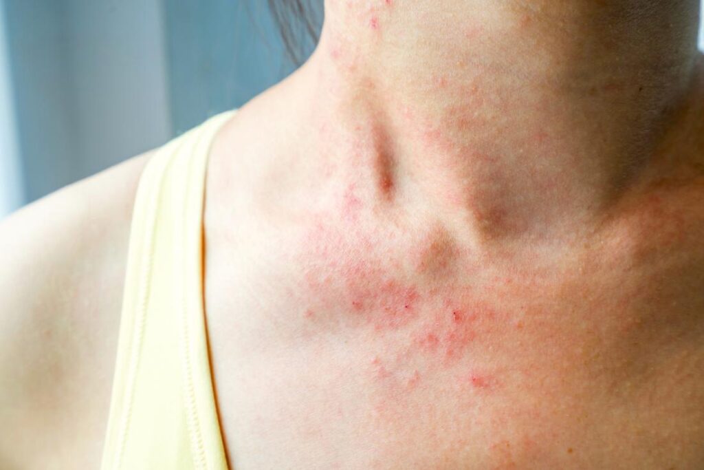 DERMATITE ATÓPICA SINTOMAS CAUSAS E TRATAMENTOS