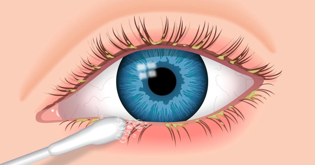 tratamento para blefarite 1024x538 - BLEFARITE SINTOMAS CAUSAS E TRATAMENTOS