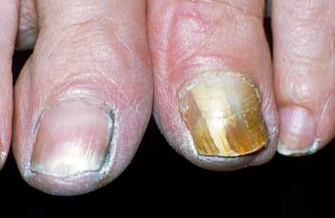 MUDANÇA DE FORMA OU CRESCIMENTO - UNHAS, PRINCIPAIS DOENÇAS