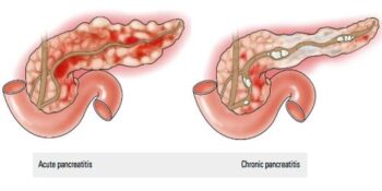 PANCREATITE SINTOMAS CAUSAS E TRATAMENTOS