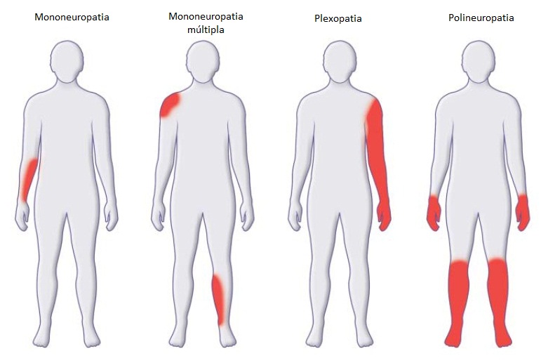 TIPOS DE NEUROPATIA PERIFÉRICA - NEUROPATIA PERIFÉRICA SINTOMAS CAUSAS TRATAMENTOS